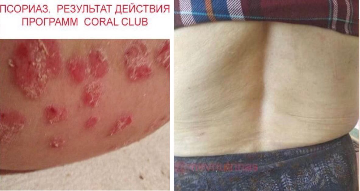 ПСОРИАЗ  - РЕЗУЛЬТАТЫ ПРИМЕНЕНИЯ ПРОГРАММ CORAL CLUB ЗА 9 МЕСЯЦЕВ